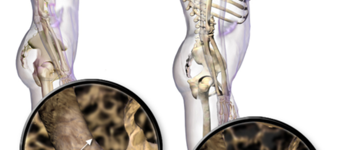 Osteoporose