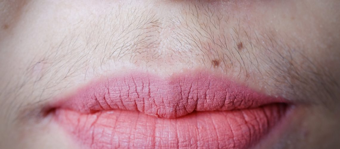 Excesso de pelos
